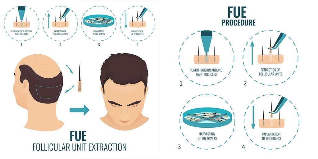 FUE-PROCEDURE-IMAGE-DESCRIPTION