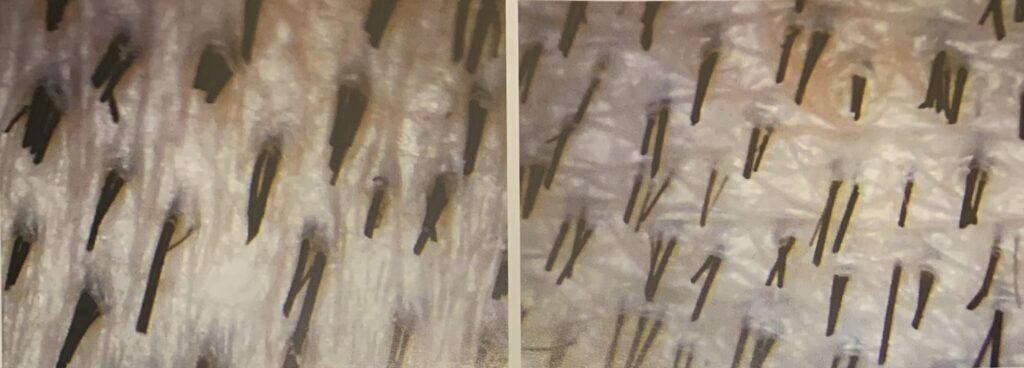 Densitometer use hair transplant