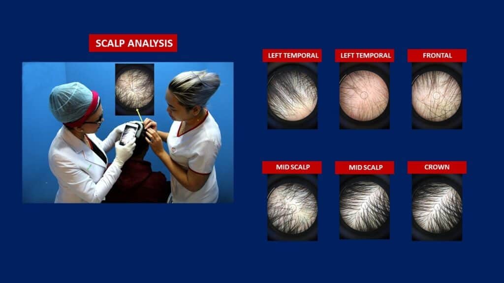 hair transplant scalp analysis