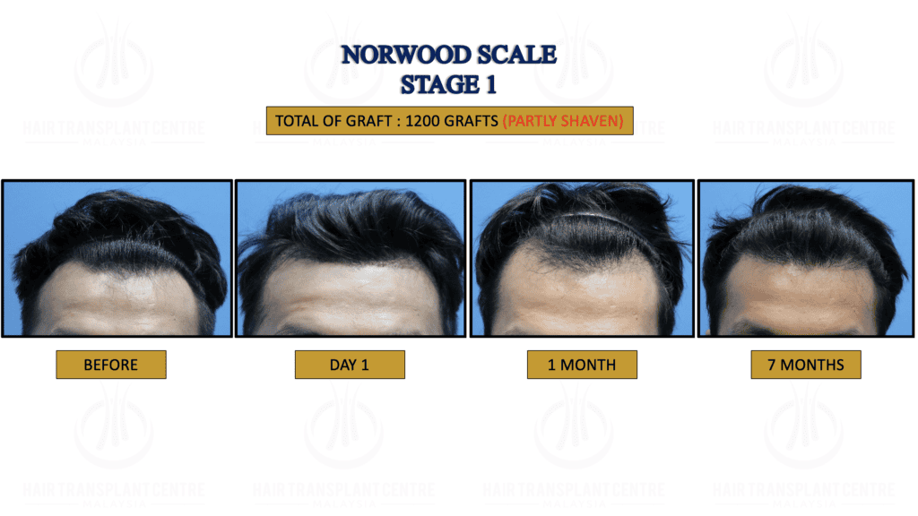 1. NORWOOD STAGE 1