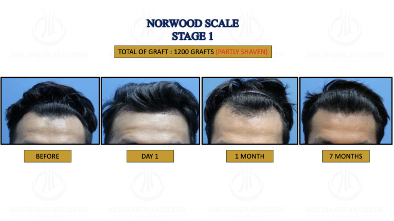 1. NORWOOD STAGE 1
