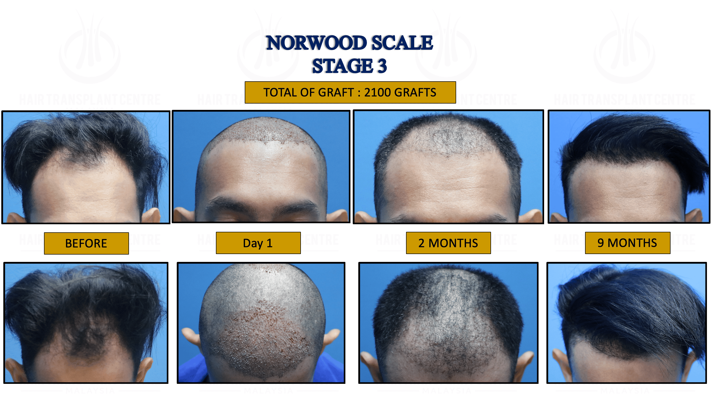 3. NORWOOD STAGE 3 1.