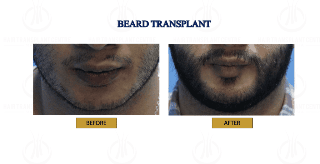 BEARD TRANSPLANT