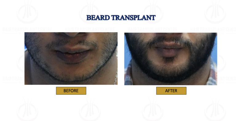 BEARD TRANSPLANT