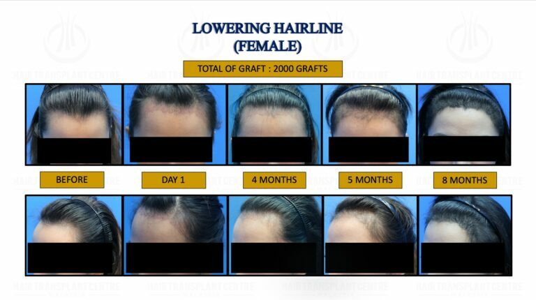 LOWERING HAIRINE ( FEMALE ) 1