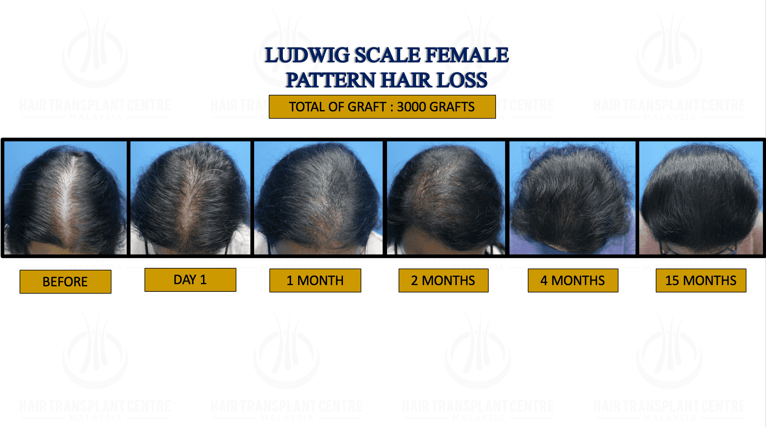LUDWIG SCALE FEMALE PATTERN HAIR LOSS