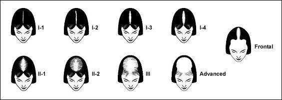 female hair loss