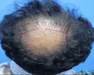 crown before