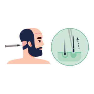 FUE Hair Transplant - Procedure Step 1