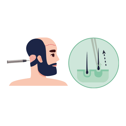 FUE Hair Transplant Step 1