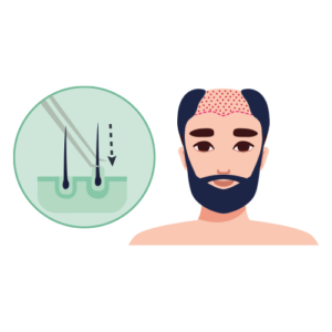 FUE Hair Transplant Step 3