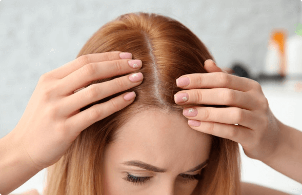 FUE-FEMALE-PATTERN-B (1)