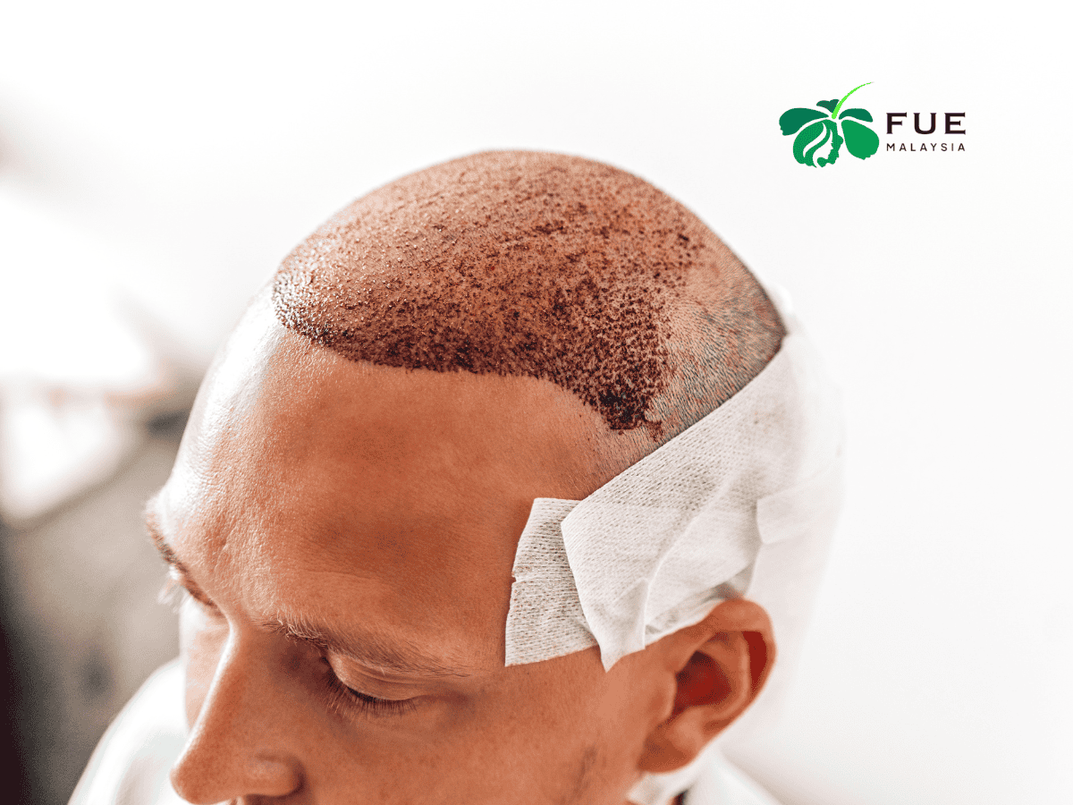 FUE Hair Transplant in Malaysia Your Comprehensive Guide to Regrowing Confidence