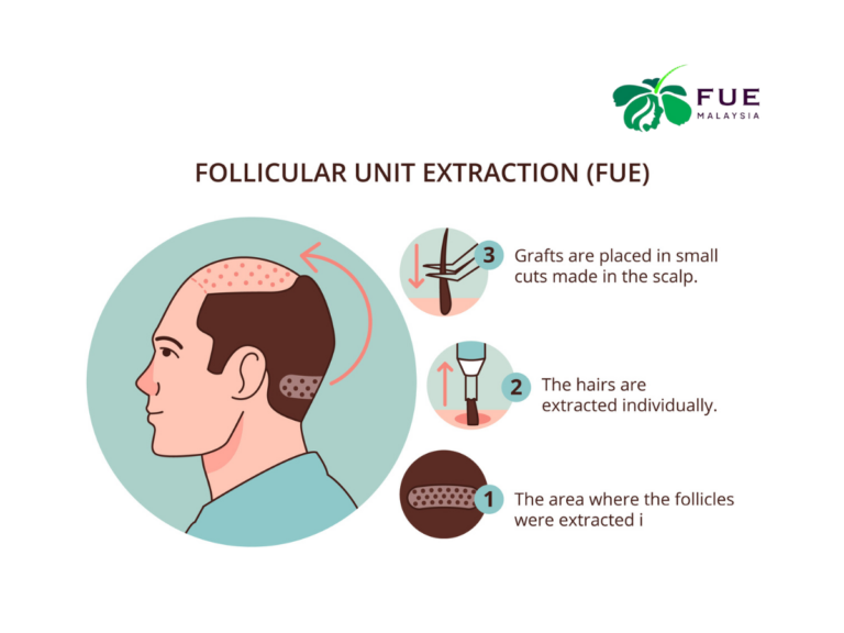 Hair Graft Malaysia Everything You Need to Know About Hair Transplantation (2)