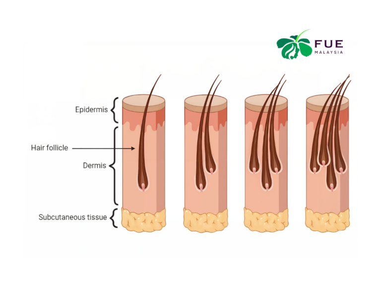 Hair Graft Malaysia Everything You Need to Know About Hair Transplantation (3)