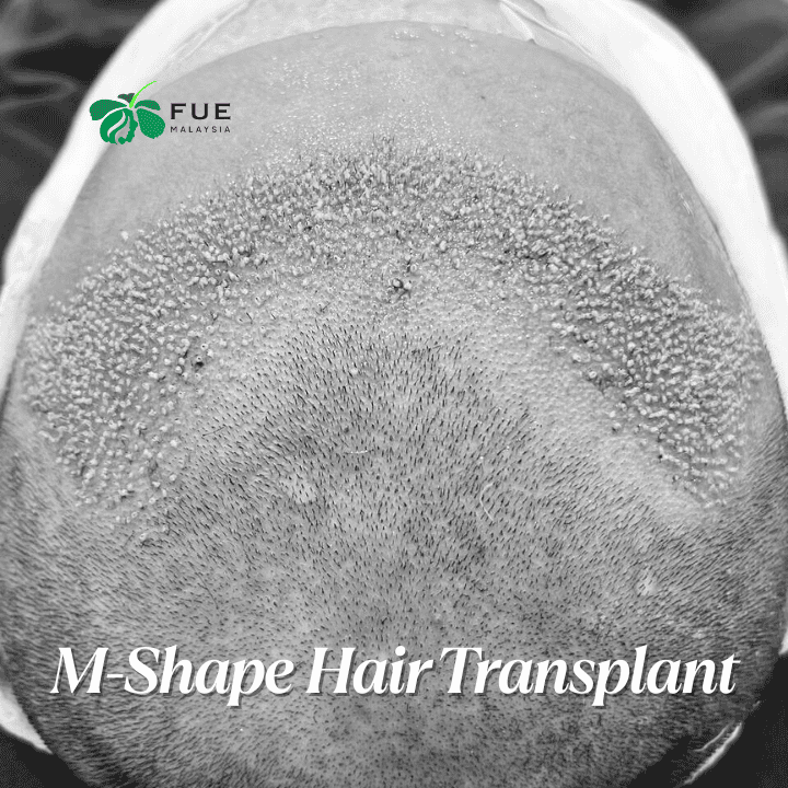 M-Shape Hair Transplant