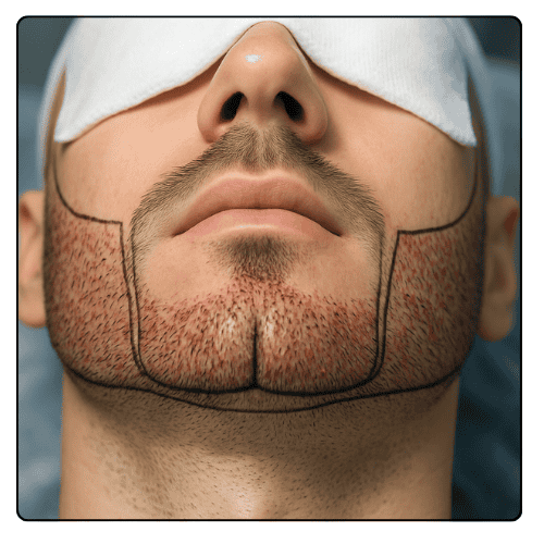 Beard Transplant