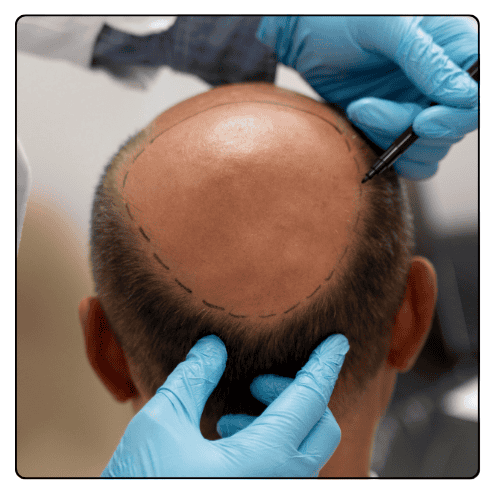 Crown Hair Transplant