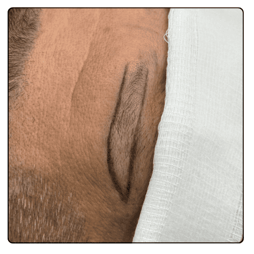 Eyebrow Hair Transplant