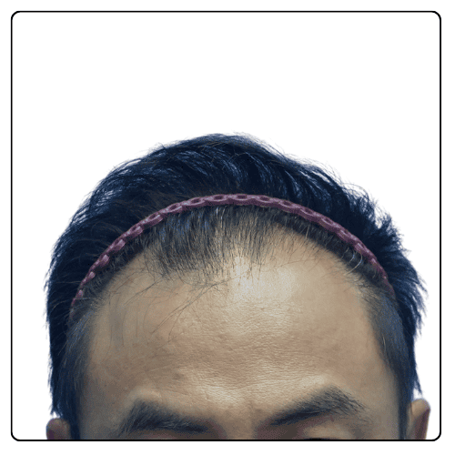 Receding hairline Hair Transplant