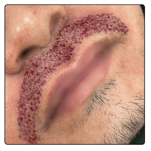 Moustache Transplant