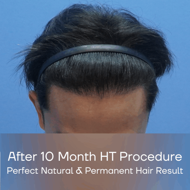 FUE Malaysia - After 10 Month HT Procedure