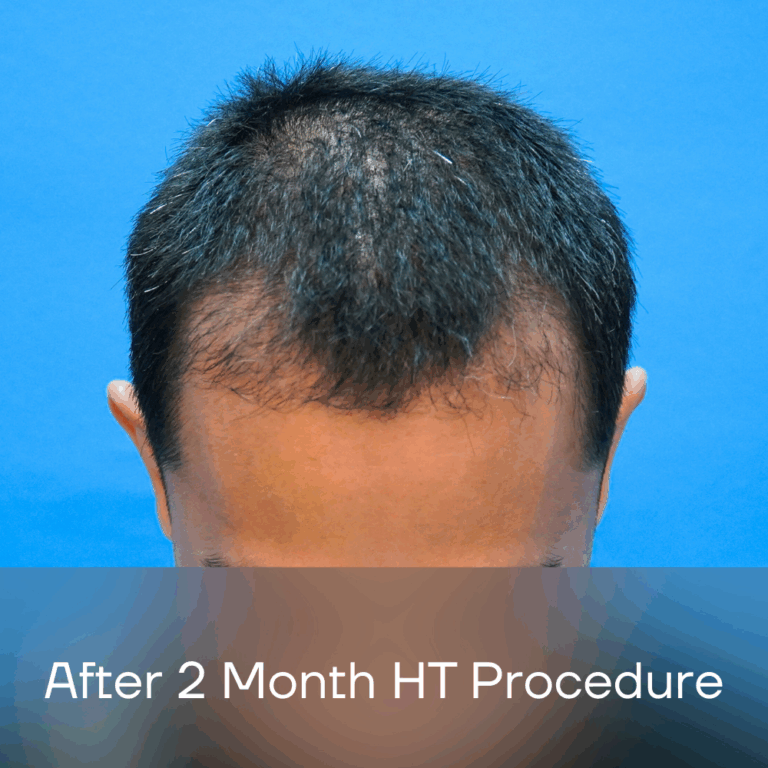 Fue Malaysia - After 2 Month HT Procedure
