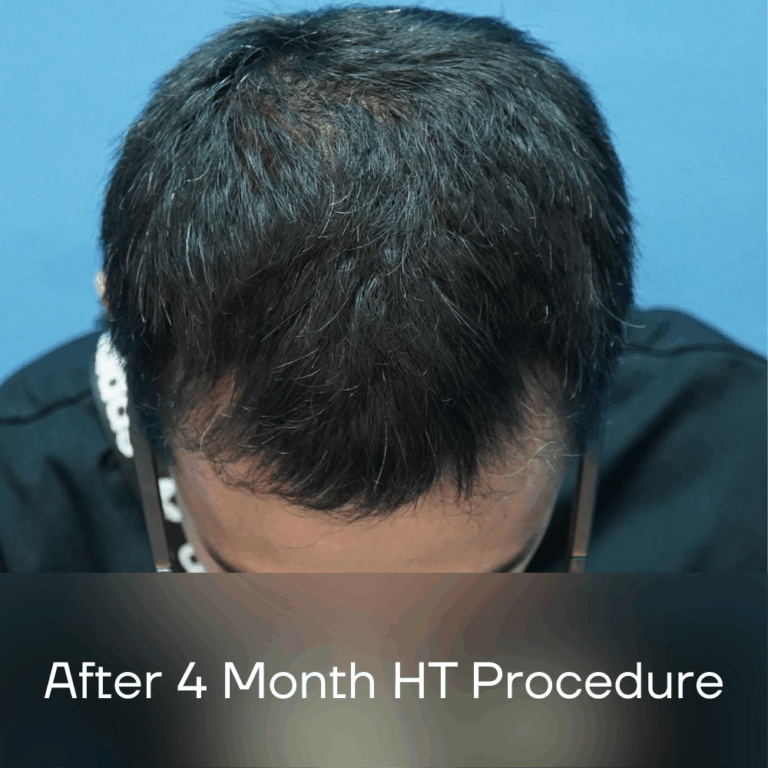 FUE Malaysia - After 4 Month HT Procedure