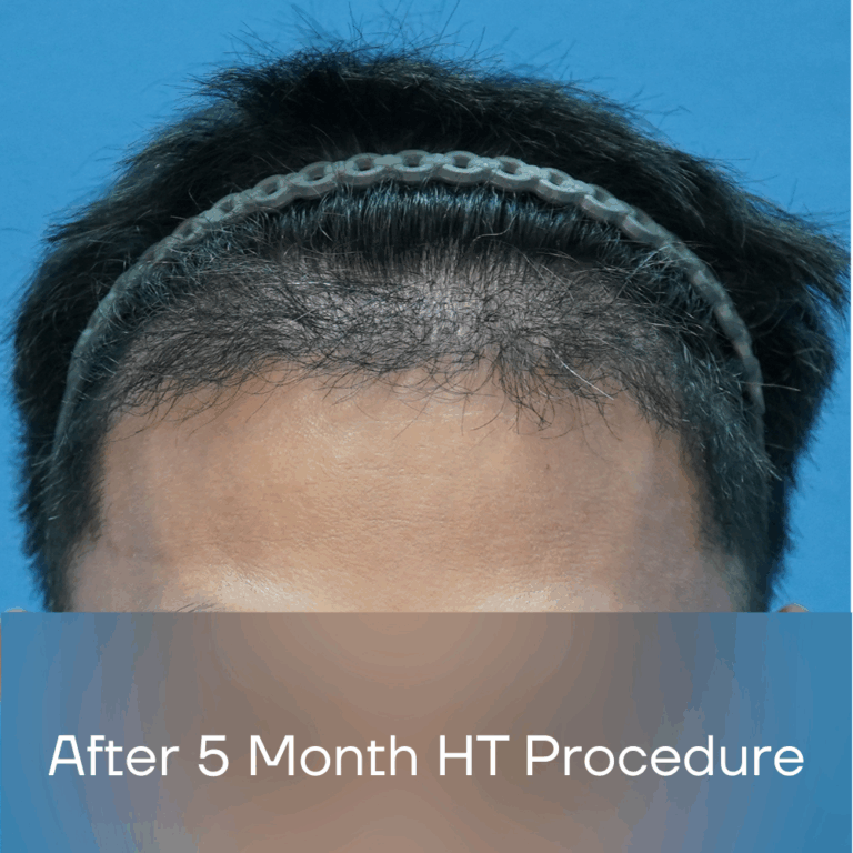 FUE Malaysia - After 5 Month HT Procedure