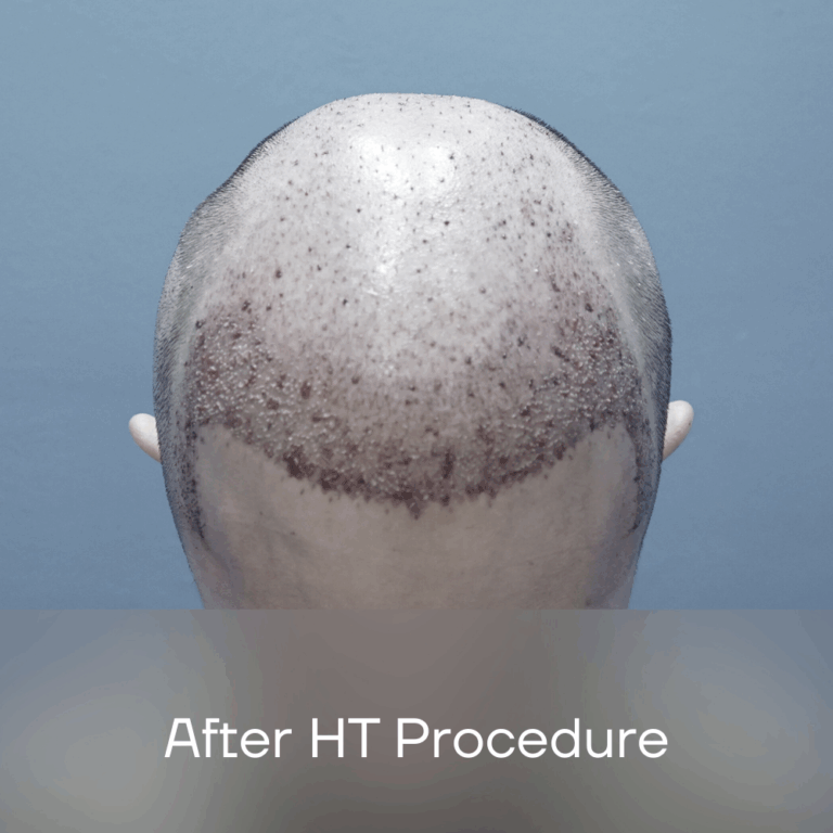 FUE Malaysia - After HT Procedure