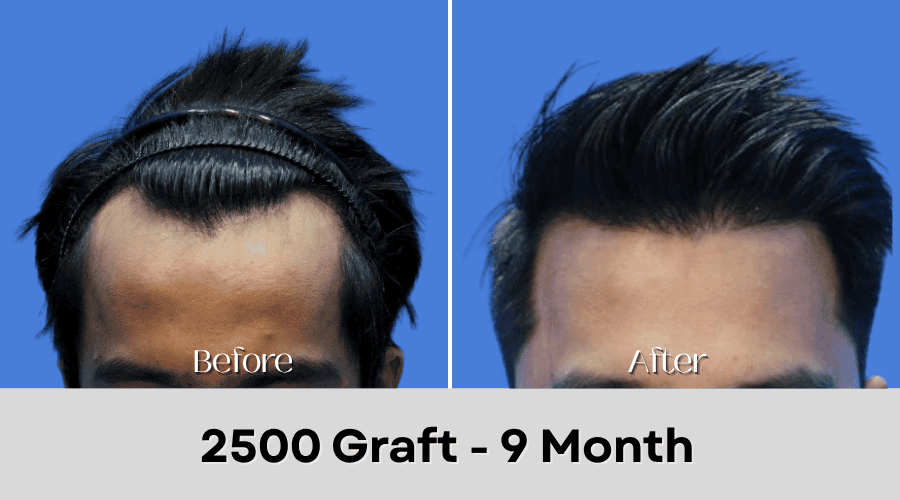 Hair Transplant Malaysia - 2500 Graft - 9 Month