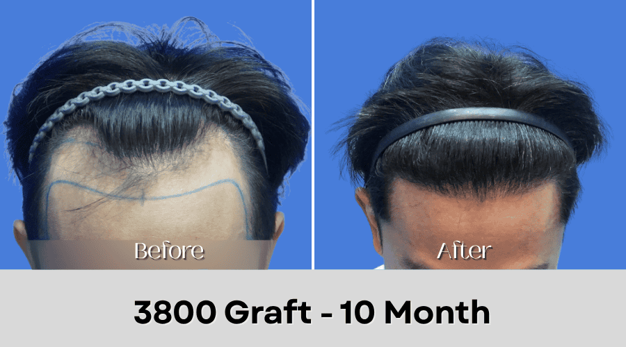 Hair Transplant Malaysia - 3800 Graft - 10 Month