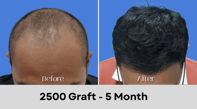Hair Transplant Malaysia - 2500 Graft - 5 Month