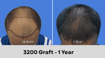 Hair Transplant Malaysia - 3200 Graft - 1 Year