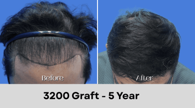Hair Transplant Malaysia - 3200 Graft - 5 Year