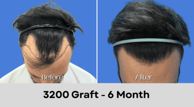 Hair Transplant Malaysia - 3200 Graft - 6 Month