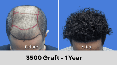 Hair Transplant Malaysia - 3500 Graft - 1 Year
