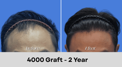 Hair Transplant Malaysia - 4000 Graft - 2 Year